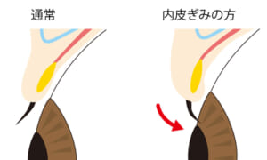 内反の構造（断面図）