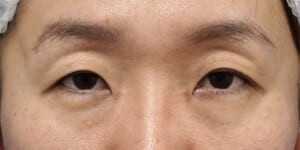 くぼみ目改善、挙筋前転②　手術前