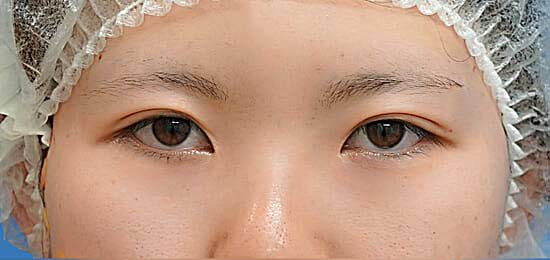 二重埋没（もとびアイライト）　術後3か月のBefore写真