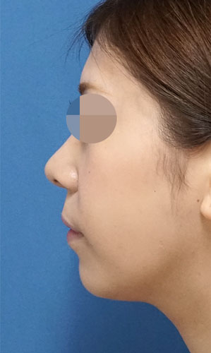 小顔脂肪吸引(ホホ・アゴ下) 手術前 左側面