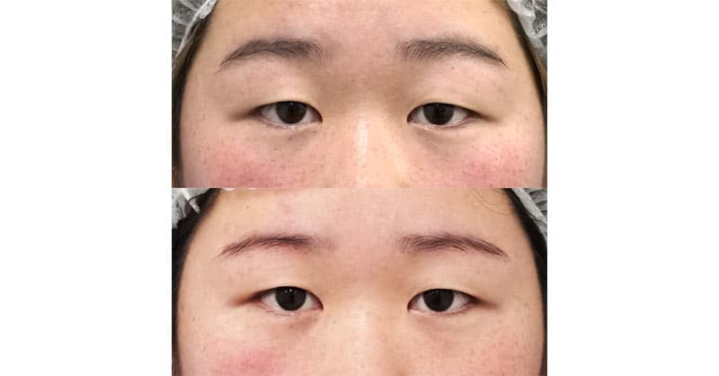 二重全切開の前に眉下切開で目元をすっきり｜眉下切開　１０ヶ月後