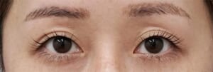 切らない眼瞼下垂プレミアム　術前.jpg