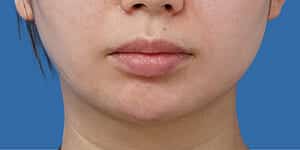 顎ヒアルロン酸 術前 正面
