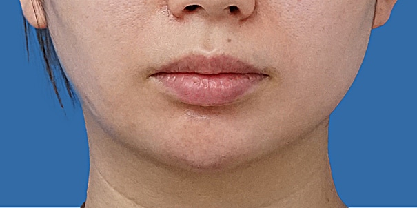 顎ヒアルロン酸 正面 術直後のBefore写真