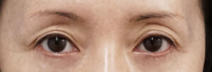 目の上ヒアルロン酸　処置前