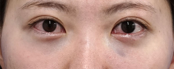 くま取り手術（裏ハムラ法）　手術直後