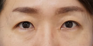 くぼみ目改善、挙筋前転②　３ヶ月後