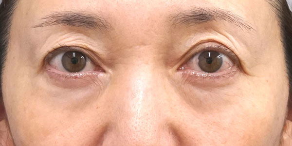 目の下たるみ取り（表ハムラ） 術前