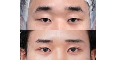 上まぶたのたるみを取って目をすっきり、大きく｜眉下切開　1ヶ月後