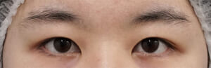 眉下術前