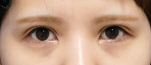 二重全切開症例写真　術後