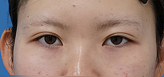 二重埋没（もとびアイライト）　術後3か月のAfterの写真