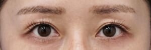 切らない眼瞼下垂プレミアム　術後