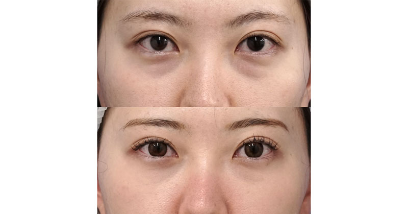 裏ハムラで目の下のクマをすっきり｜裏ハムラ　術直後～２ヶ月後、ダウンタイムの画像も