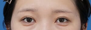 眉下切開 術後6か月
