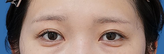 眉下切開 術後6か月のAfterの写真