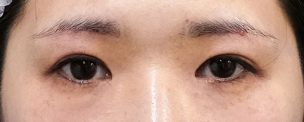 外眼角形成術（目尻切開＋じん帯移動術）　３ヶ月後のBefore写真