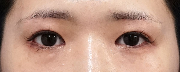 外眼角形成術（目尻切開＋じん帯移動術）　３ヶ月後のAfterの写真