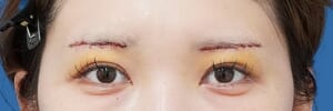 眉下切開 術後5日（抜糸直後）