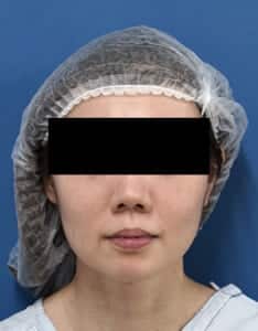 顔正面(手術前)