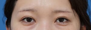 眉下切開 術後3か月
