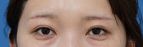 眉下切開 術後3か月のAfterの写真