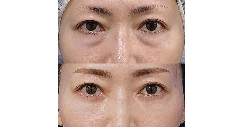 ダウタイムの少ない目の下のくまとり手術｜目の下脂肪取り・脂肪注入　３ヶ月後