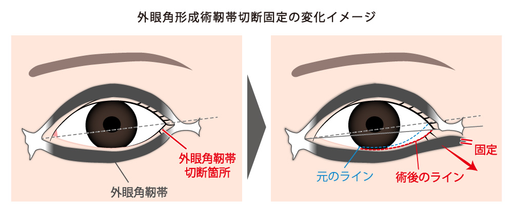 外眼角形成術靭帯切断固定の変化イメージ