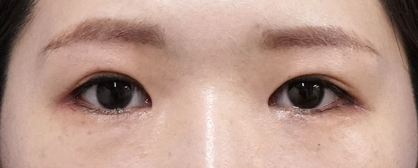 外眼角形成術（目尻切開＋じん帯移動術）　１２日後のAfterの写真