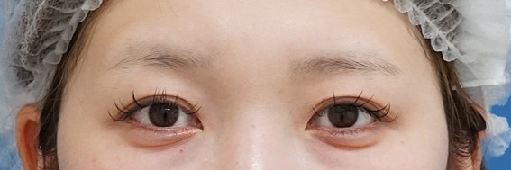 眉下切開 術後6か月のBefore写真