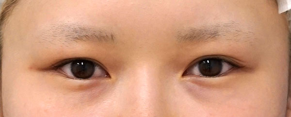 眉下切開　６ヶ月後のBefore写真