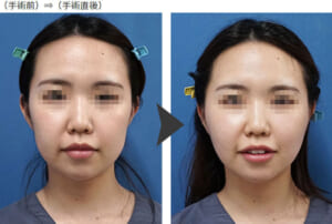 症例3VOVコグリフト直後