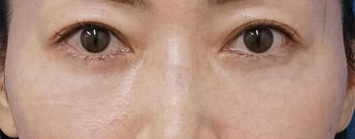 目の下脂肪取り・脂肪注入　３ヶ月後