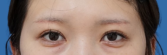 眉下切開 術後1か月のAfterの写真