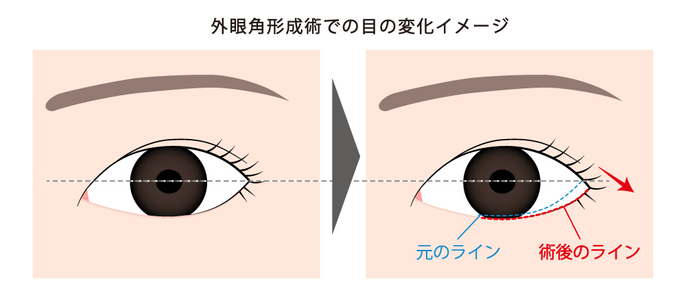 外眼角形成術での目の変化イメージ