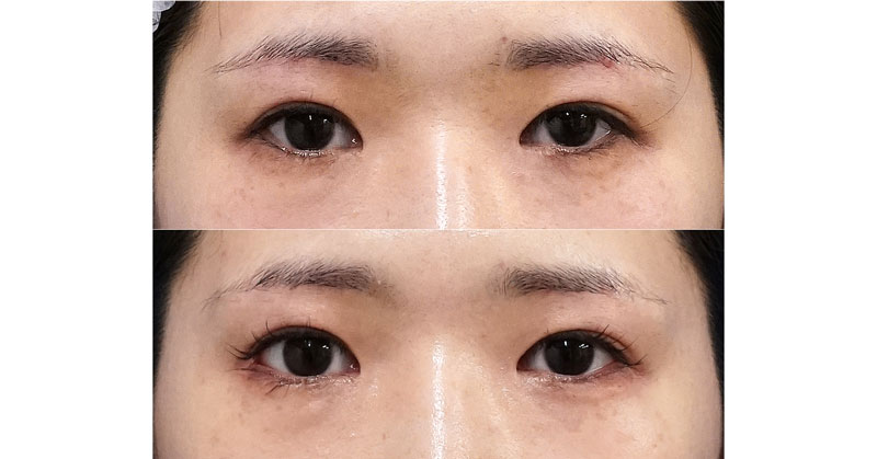 しっかり白目を大きく｜外眼角形成術（目尻切開＋じん帯移動術）　３ヶ月後