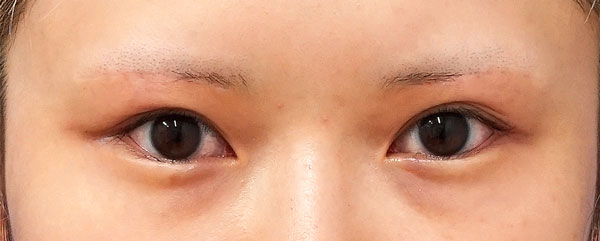 眉下切開　６ヶ月後のAfterの写真