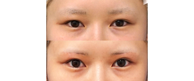 二重埋没法で満足できなかった方に｜眉下切開　６ヶ月後
