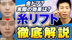 糸リフトは意味ある？SNSで金ドブと言われていても、おすすめできる理由