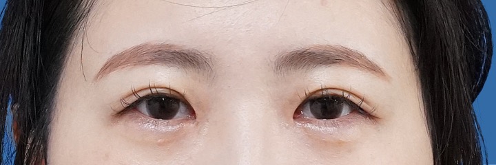 目頭切開（リドレープ法）　術後1か月のAfterの写真