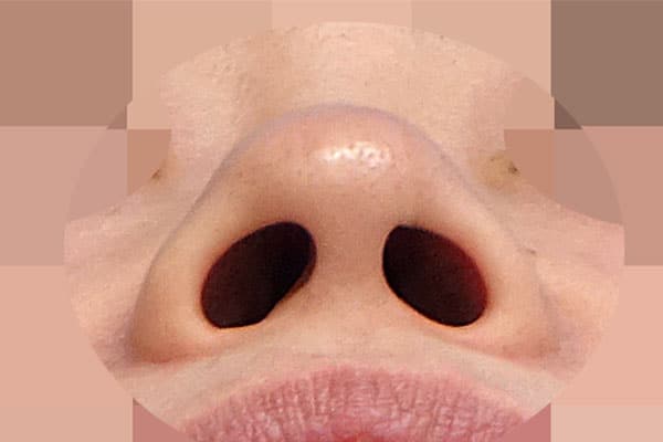 鼻尖形成・鼻中隔延長　手術前　下から