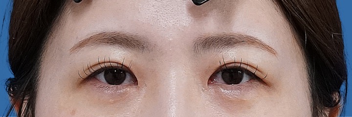 目頭切開（リドレープ法） 術後6か月のAfterの写真