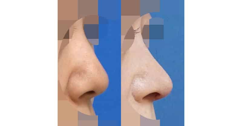 鼻先の高さをしっかり出して整える｜鼻中隔延長＋鼻尖形成　１週間後（抜糸直後）