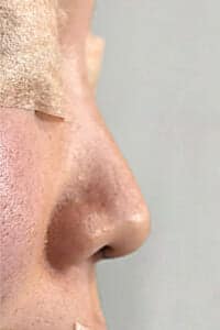 鼻中隔延長　手術前　左側面