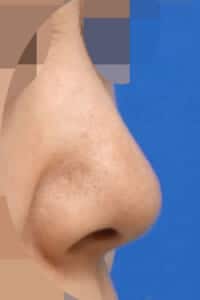 鼻尖形成・鼻中隔延長　手術前　右斜め　