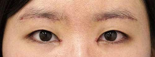 眉下切開＋目頭切開Z形成　１週間後のAfterの写真