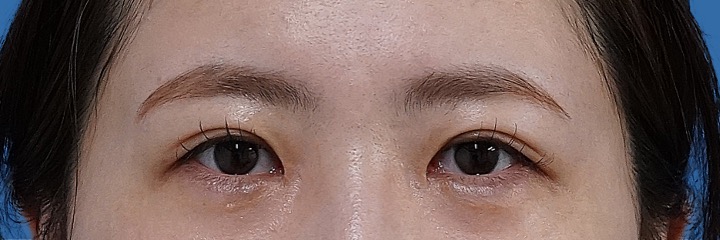 目頭切開（リドレープ法） 術後3か月のAfterの写真