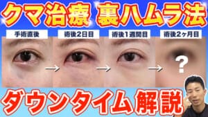 目の下のクマ取り】裏ハムラ法のダインタイムと術後の過ごし方を解説