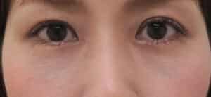 裏ハムラ1ヶ月後