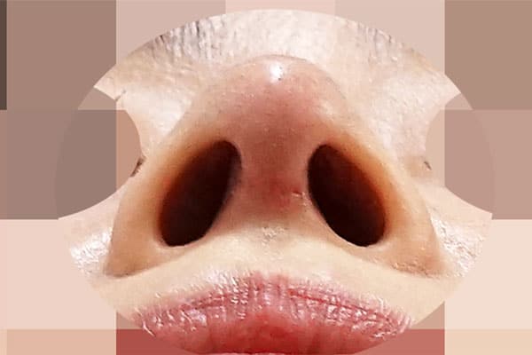 鼻尖形成・鼻中隔延長　１週間後　下から